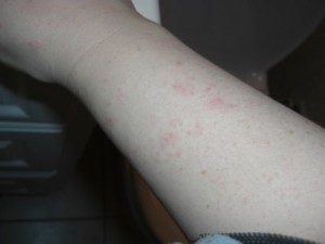 Right arm after allergic reaction to J&J baby shampoo (thick & curly)