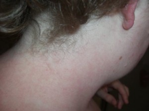 Back of neck after allergic reaction to J&J baby shampoo (thick & curly)
