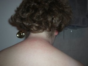 Angry, Itchy, Painful neck after allergic reaction to J&J baby shampoo (thick & curly)