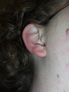 My angry allergic reaction ear