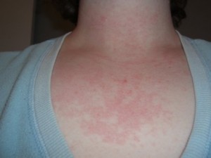 Chest after allergic reaction to J&J baby shampoo (thick & curly)
