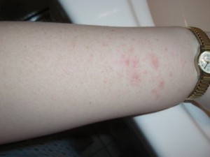 Left arm after allergic reaction to J&J baby shampoo (thick & curly)